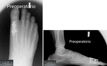 ecografía prequirúrgica de un paciente al que se le realiza una liberación nerviosa en el pie
