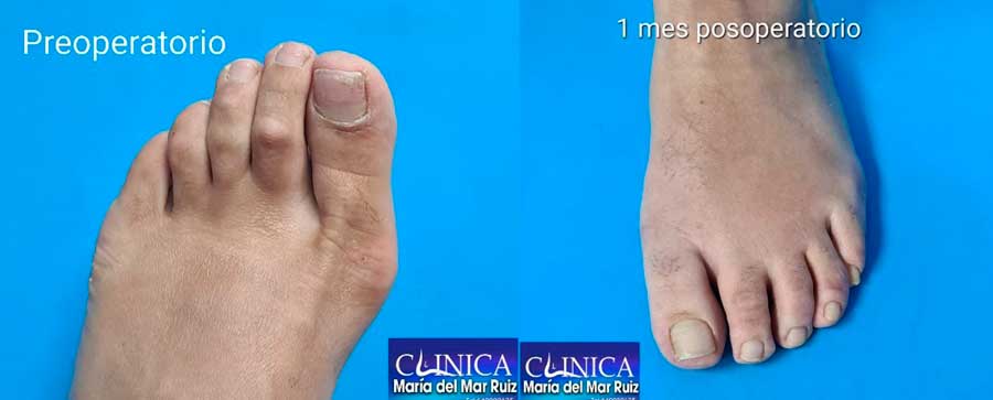 -cirugía-ecoguiada-de-pie-y-tobillo-clínica-Mª-del-Mar-Ruiz