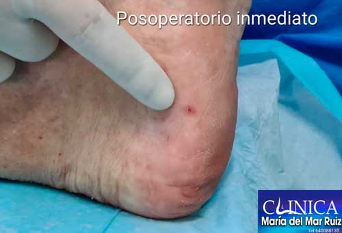 incisión de la cirugía ecoguiada de pie y tobillo