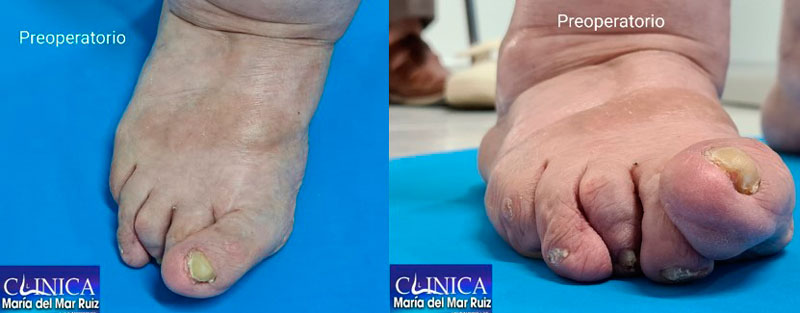 antes y después de una cirugía del pie