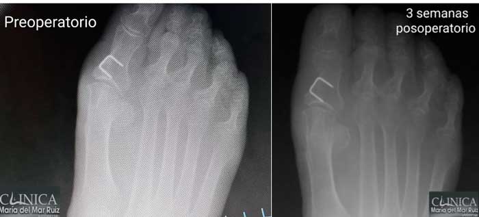radiografía en la que se aprecia hipertrofia de hueso con la compresión del calzado, produce un callo o heloma muy doloroso