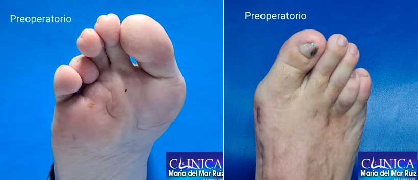 Imagen-antes-y-después-de-la-cirugía-por-dolor-en-el-dedo-gordo-del-pie