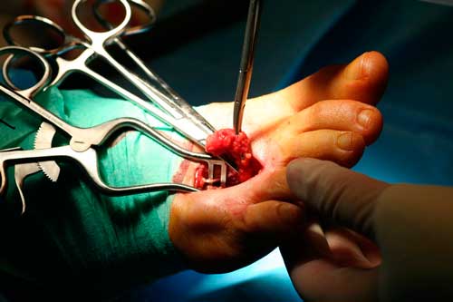 operación de neuroma de Morton con mínima incisión