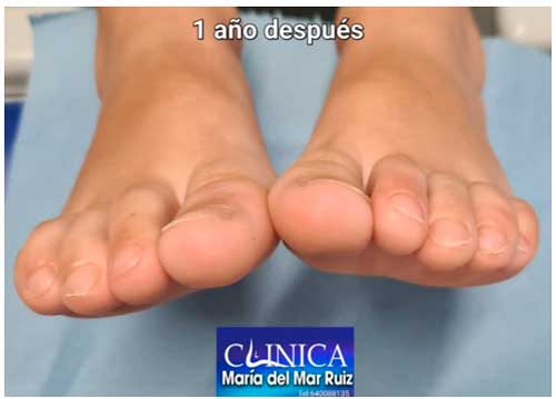 Resultados de la Cirugía de los Dedos Torcidos o Dedos Infraaductus de los Pies