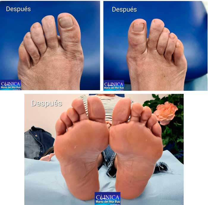 El aspecto de los pies de María Virtud 6 meses después de la cirugía de juanetes