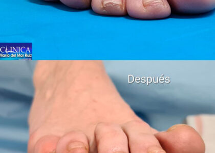 Antes y después de la cirugía de Dedos torcidos (infraductus) en adultos