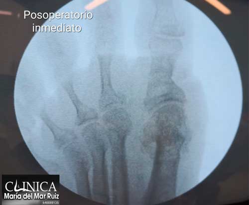 Radiografía postoperatorio con Cirugía Mínimamente Invasiva para Dedos en Martillo y Juanetes