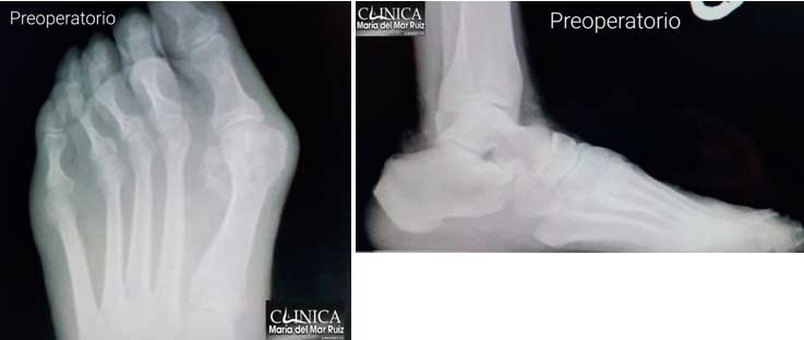 Radiografías preoperatorias Cirugía para Dedos en Martillo y Juanetes