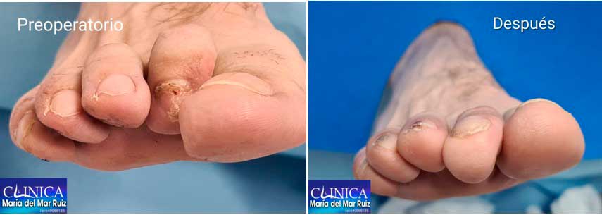 Resultados de corrección de dedo en garra con cirugía mínimamente invasiva