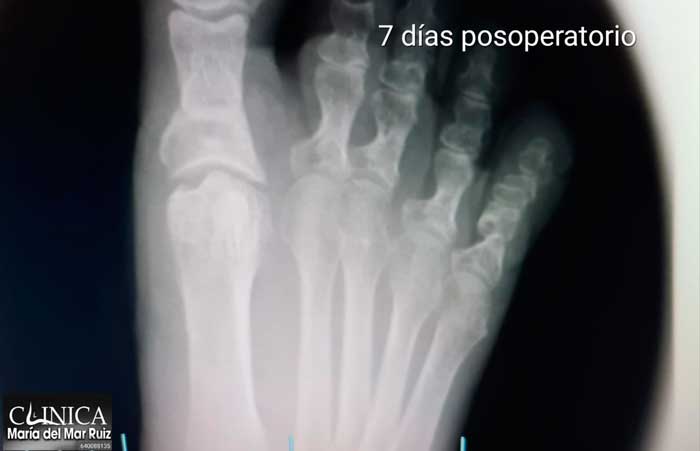 Radiografía de un pie operado de Hallux Rígidus a los 7 días de la operación