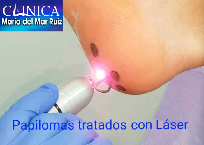 Tratamiento papilomas mediante K-Laser.